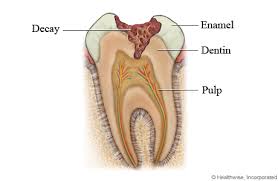 cross section of a tooth with a cavity