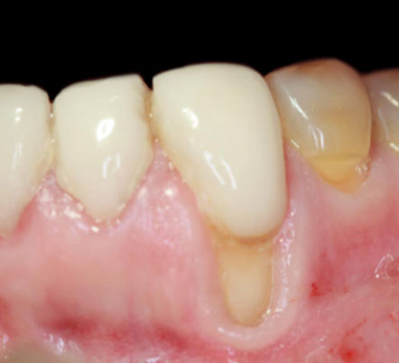 before image of gum disease