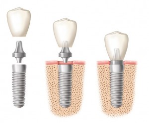 tooth implant dublin