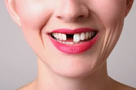 when to get dental implants