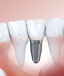 Close up illustration of a ceramic dental implant in a jawline beside normal teeth