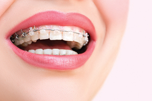 Close up of smiling female dental patient with Ceramic Braces on her upper teeth