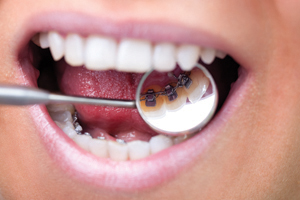 Close up of female Dental Patient with Lingual Braces inserted at the rear of her teeth