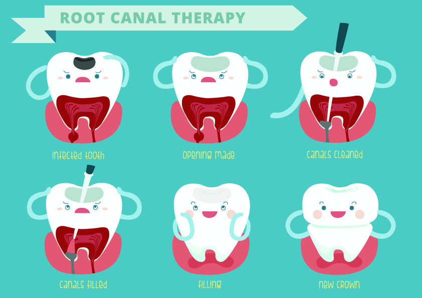 Root Canal Treatment explained from the experts at Dental House