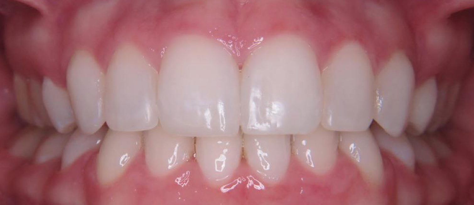 Close up of teeth after Smile Design Composite Bonding in Dublin treatment