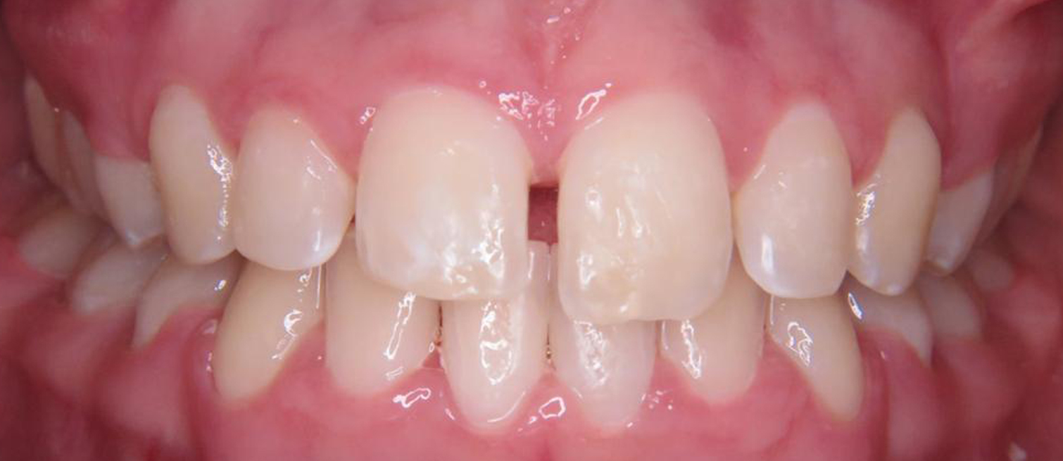 Teeth before Smile Design Composite Bonding treatment in Dublin dental clinic