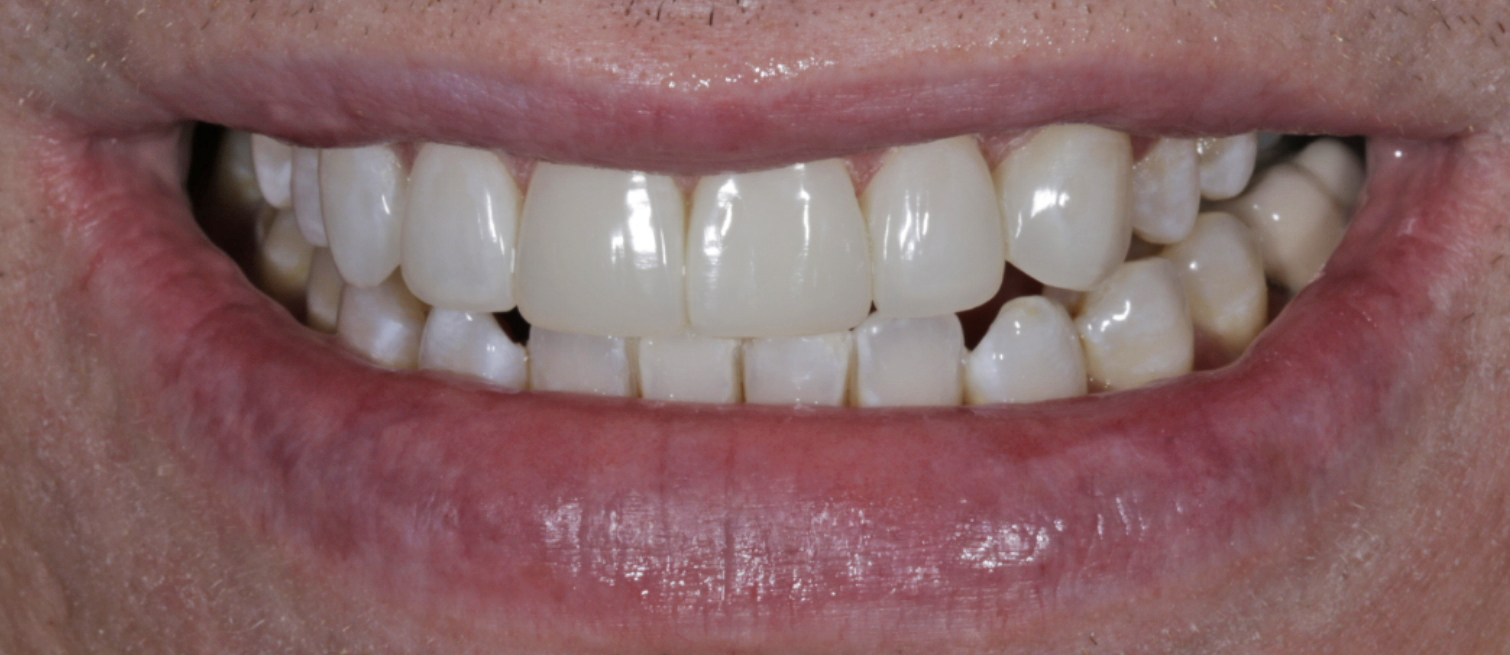 Patient's teeth after Smile Design Composite Bonding in Dublin