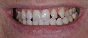 Patient's teeth before Smile Design Composite Bonding treatment in Dublin