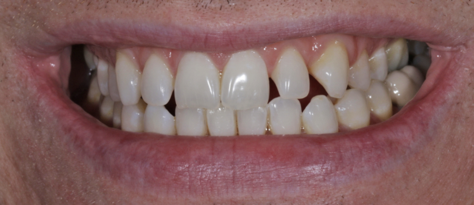 Patient's teeth before Smile Design Composite Bonding treatment in Dublin