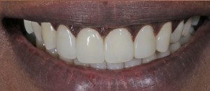 Crooked teeth fixed after Composite Bonding treatment in Kildare