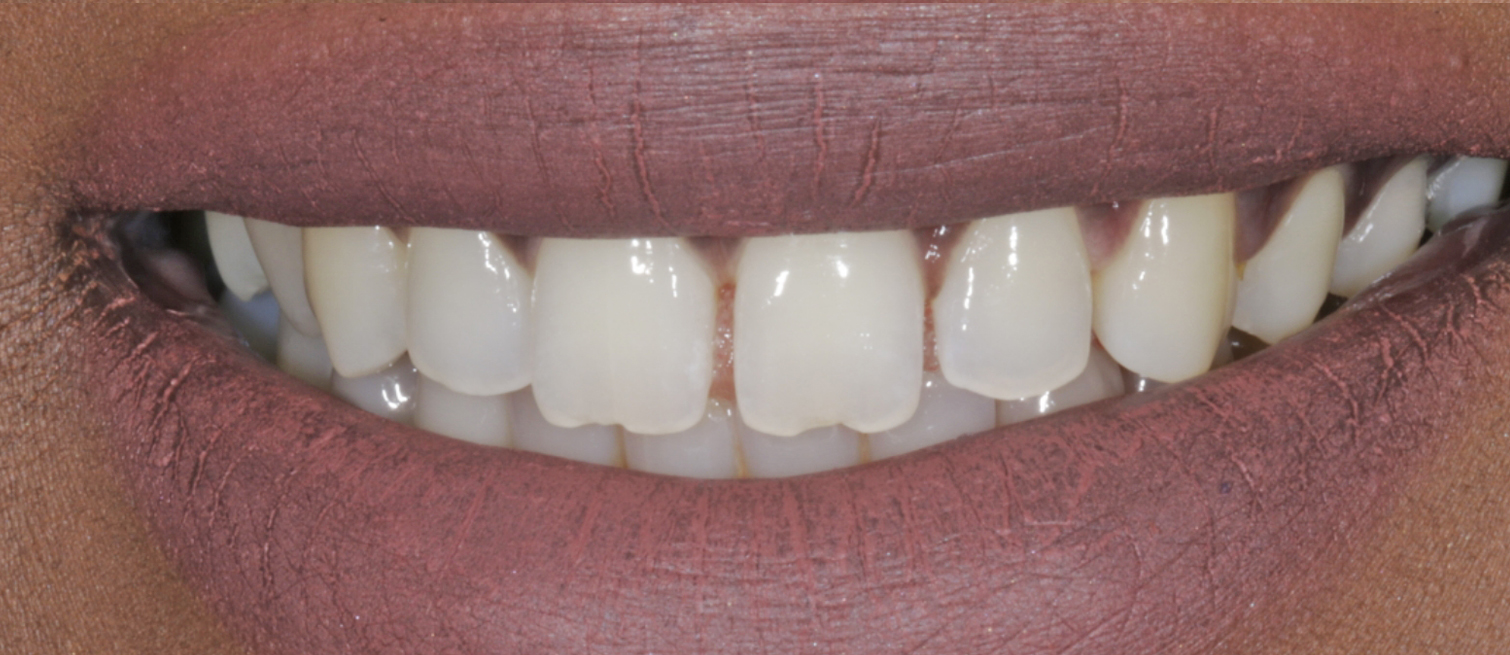 Crooked teeth before Composite Bonding treatment in Kildare