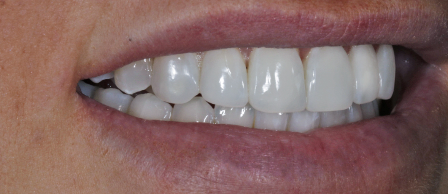 Previously damaged teeth after Composite Bonding dentist in Maynooth treatment