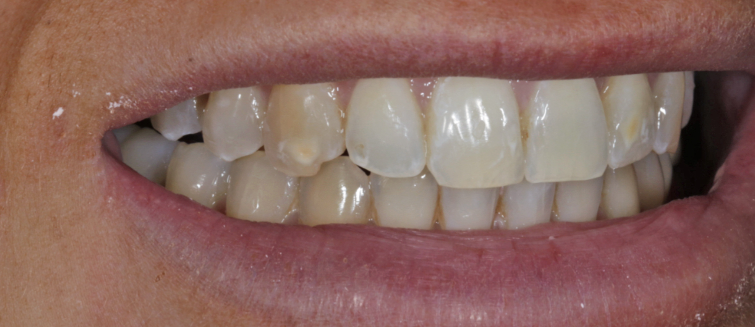 Damaged teeth before Composite Dental Bonding in Maynooth
