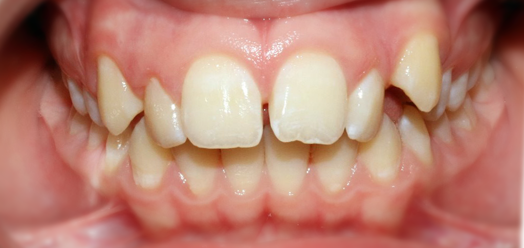 Damaged dental patient teeth