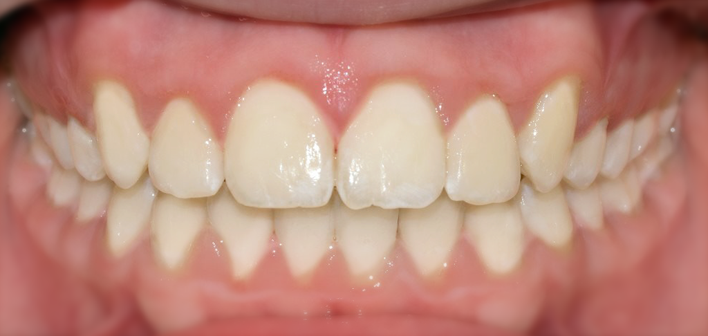 exposed dental patient teeth
