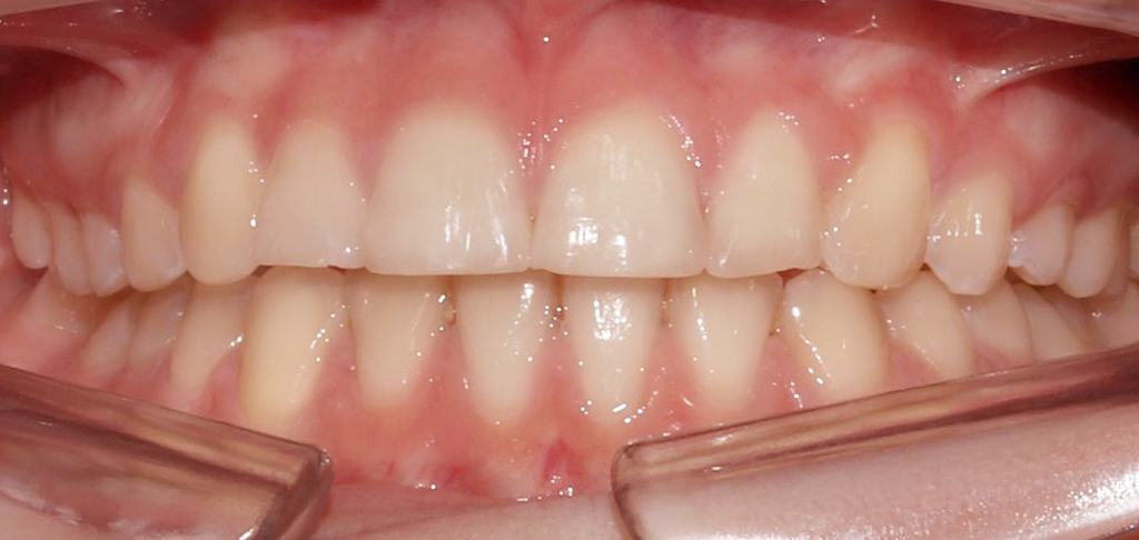 Close up of Dental patient's teeth after composite edge bonding treatment