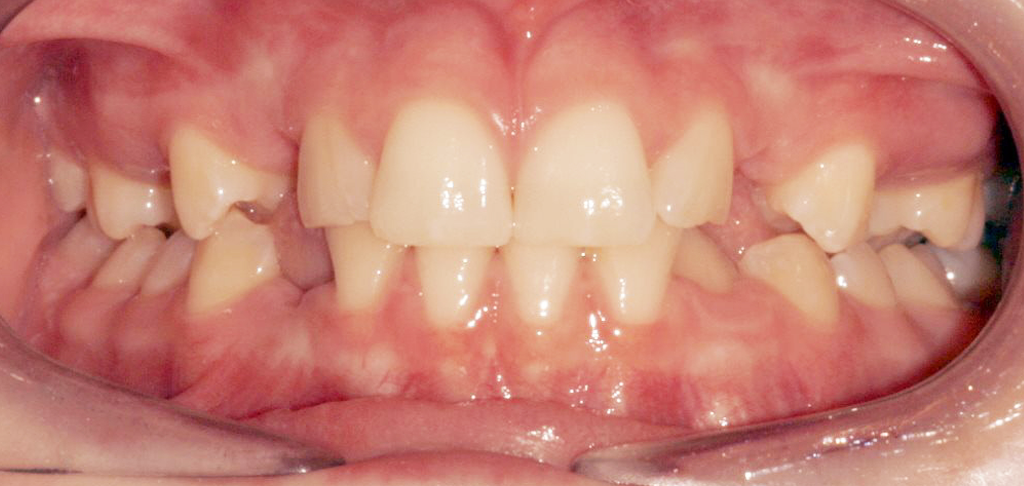 close up of patient's teeth before composite bonding treatment