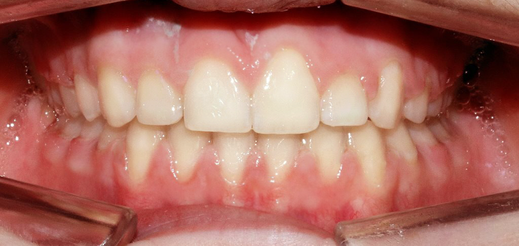 Dental patient after composite bonding treatment