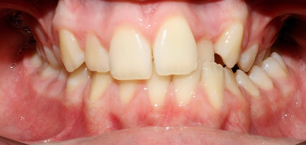 Dental Patient's teeth before composite edge bonding treatment