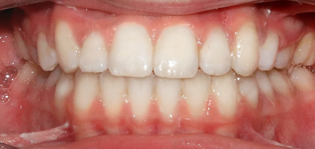 Dental patient's teeth repaired by composite bonding