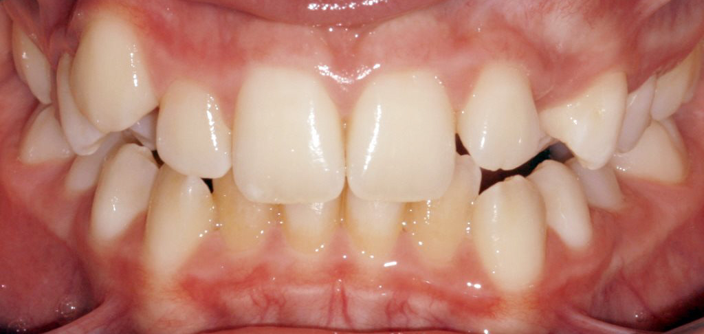 Dental Patient before composite bonding treatment