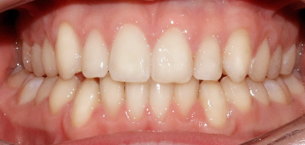 close up of patients teeth after cosmetic dentistry treatment