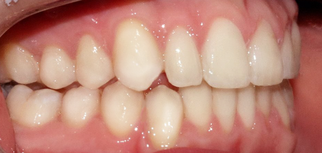 results of composite binding on close up of patients teeth