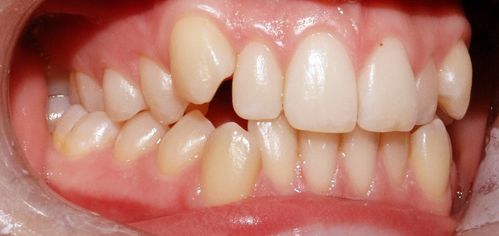 close up of patients teeth before cosmetic dentistry treatment