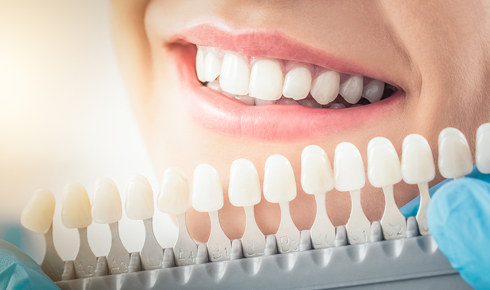 Smile Design dental patient choosing the teeth whitening colour they would like